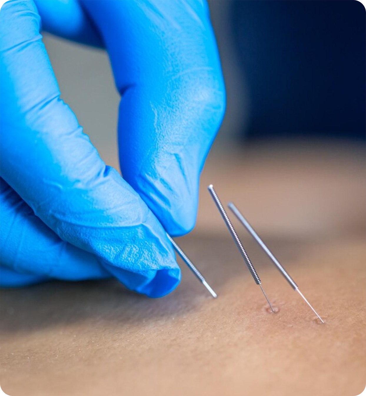Gloved hand inserting thin acupuncture needles into skin