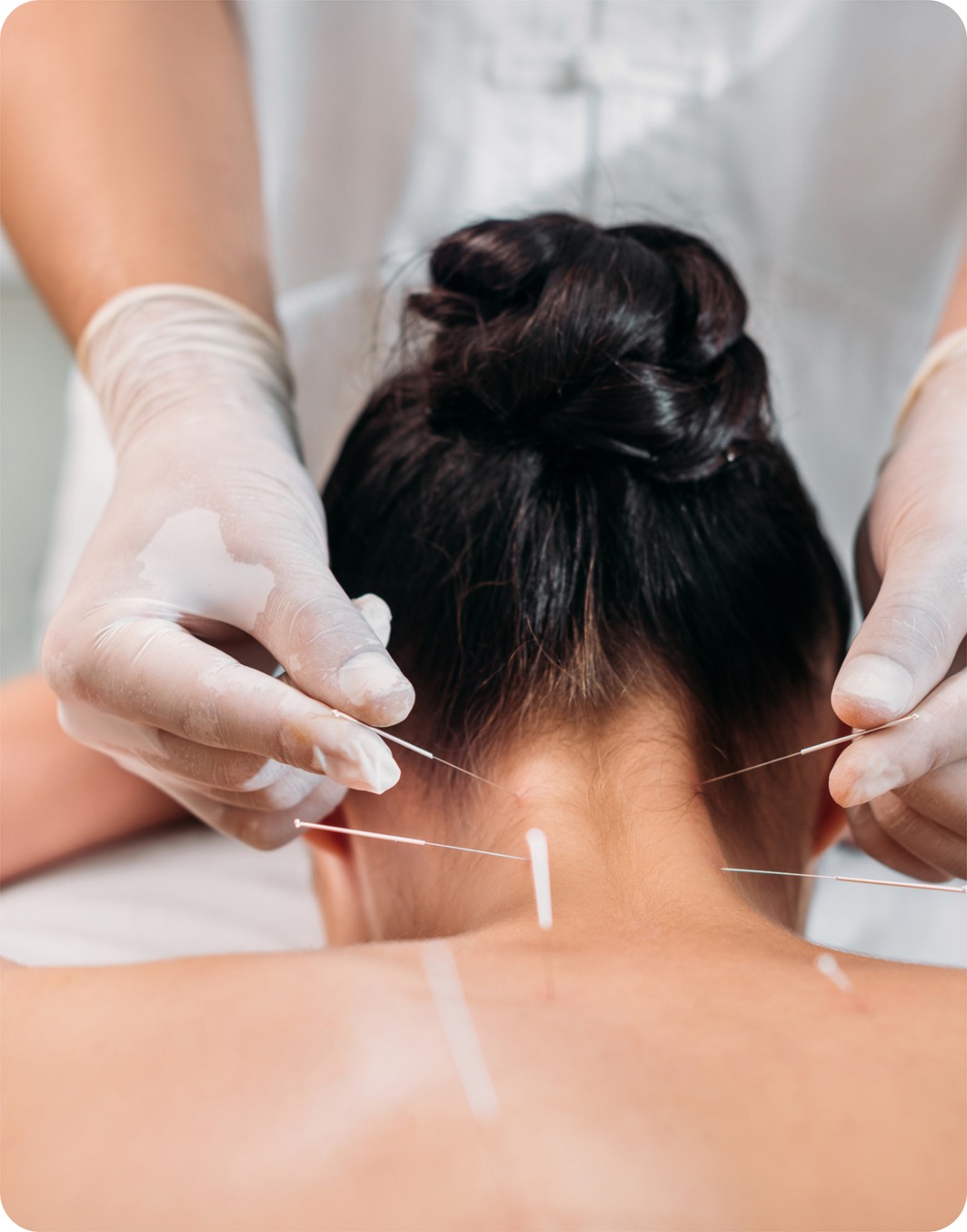 Practitioner placing acupuncture needles in a woman's neck and upper back