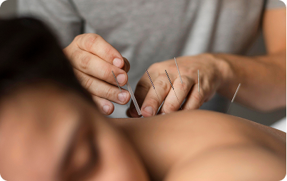Acupuncture needles placed along a patient's back